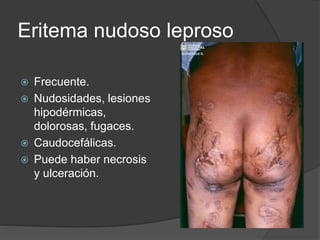 Eritema nudoso leproso
 Frecuente.
 Nudosidades, lesiones
hipodérmicas,
dolorosas, fugaces.
 Caudocefálicas.
 Puede haber necrosis
y ulceración.
 