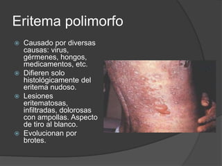Eritema polimorfo
 Causado por diversas
causas: virus,
gérmenes, hongos,
medicamentos, etc.
 Difieren solo
histológicamente del
eritema nudoso.
 Lesiones
eritematosas,
infiltradas, dolorosas
con ampollas. Aspecto
de tiro al blanco.
 Evolucionan por
brotes.
 