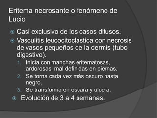 Eritema necrosante o fenómeno de
Lucio
 Casi exclusivo de los casos difusos.
 Vasculitis leucocitoclástica con necrosis
de vasos pequeños de la dermis (tubo
digestivo).
1. Inicia con manchas eritematosas,
ardorosas, mal definidas en piernas.
2. Se torna cada vez más oscuro hasta
negro.
3. Se transforma en escara y ulcera.
 Evolución de 3 a 4 semanas.
 