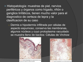  Histopatología: muestras de piel, nervios
periféricos y órganos como hígado, riñón o
ganglios linfáticos, tienen mucho valor para el
diagnostico de certeza de lepra y la
clasificacion de su caso
○ Dermis e hipodermis infiltrada por células de
aspecto espumoso, conserva las membranas,
algunos núcleos y cuyo protoplasma vacuolado
se muestra lleno de bacilos: Células de Virchow
 