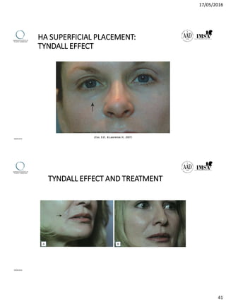 17/05/2016
41
HA SUPERFICIAL PLACEMENT:
TYNDALL EFFECT
(Cox, S.E., & Lawrence, N., 2007)
09/04/2016
TYNDALL EFFECT AND TREATMENT
09/04/2016
 
