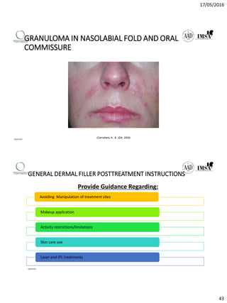 17/05/2016
43
GRANULOMA IN NASOLABIAL FOLD AND ORAL
COMMISSURE
(Carruthers, A., & JDA, 2005)
09/04/2016
GENERAL DERMAL FILLER POSTTREATMENT INSTRUCTIONS
Provide Guidance Regarding:
Avoiding Manipulation of treatment sites
Makeup application
Activity restrictions/limitations
Skin care use
Laser and IPL treatments
09/04/2016
 