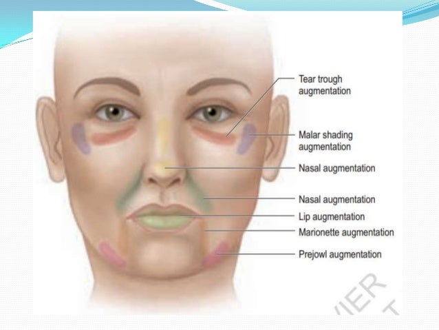 Topical Facial Fillers