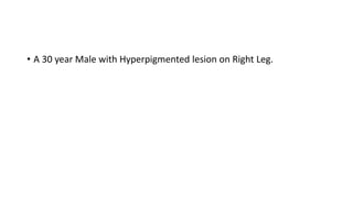 • A 30 year Male with Hyperpigmented lesion on Right Leg.
 