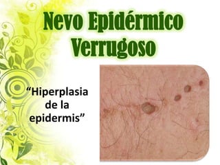 Nevo Epidérmico
      Verrugoso
“Hiperplasia
    de la
 epidermis”
 