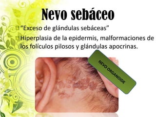 Nevo sebáceo
“Exceso de glándulas sebáceas”
Hiperplasia de la epidermis, malformaciones de
los folículos pilosos y glándulas apocrinas.
 