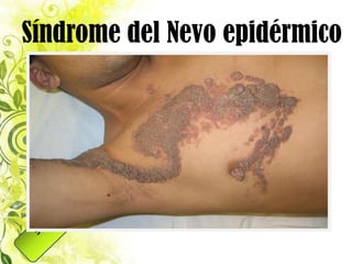 Síndrome del Nevo epidérmico
“Asociación del nevo verrugoso y nevo sebáceo
       con malformaciones de estructuras
                 extracutáneas”
    Nevo cutáneo + anomalías oculares +
       alteraciones del esqueleto + signos
                 neurológicos…
                 Retraso mental
                  Convulsiones
                  Hemiparesias
 