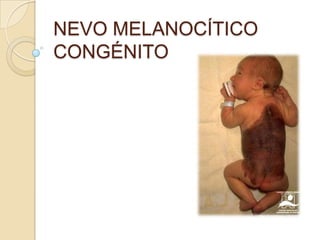 NEVO MELANOCÍTICO
CONGÉNITO
 