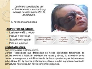 Lesiones constituidas por
       colecciones de melanocitos y
        células névicas presentes la
                 nacimiento.

    1% nevos melanocíticos

 ASPECTOS CLÍNICOS:
  Lesiones café o negro
  Planas o elevadas                                                Nevos congénitos
                                Nevo congénito         Nevos
                                                                        grandes o
  Superficie irregular       pequeños (menos de     congénitos      gigantes (> 10 y
                                    3cm.)             medianos           20 cms)
  Pelo en lesiones

HISTOPATOLOGÍA:
Son compuestos o intradérmicos.
Caract. Histológicas que diferencian de nevos adquiridos: tendencias de
celulas nevicas a localizar alrededor de nexos y vasos, su extensión entre
haces de colágenos y la infiltración de la dermis profunda y el tejido celular
subcutáneo. En la dermis profunda las células pueden agruparse formando
estructuras neuroides. En nevos congénitos gigantes.
 