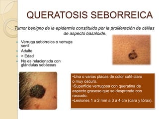 QUERATOSIS SEBORREICA
Tumor benigno de la epidermis constituido por la proliferación de célilas
                        de aspecto basaloide.
 Verruga seborreica o verruga
  senil
 Adulto
 > Edad
 No es relacionada con
  glándulas sebáceas

                              •Una o varias placas de color café claro
                              o muy oscuro.
                              •Superficie verrugosa con queratina de
                              aspecto grasoso que se desprende con
                              rascado.
                              •Lesiones 1 a 2 mm a 3 a 4 cm (cara y tórax).
 