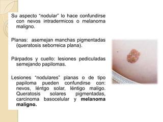 Su aspecto “nodular” lo hace confundirse
  con nevos intradermicos o melanoma
  maligno.

Planas: asemejan manchas pigmentadas
  (queratosis seborreica plana).

Párpados y cuello: lesiones pediculadas
  semejando papilomas.

Lesiones “nodulares” planas o de tipo
  papiloma pueden confundirse con:
  nevos, léntgo solar, léntigo maligo.
  Queratosis   solares    pigmentadas,
  carcinoma basocelular y melanoma
  maligno.
 