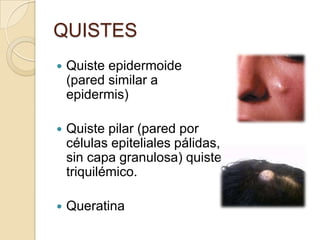 QUISTES
   Quiste epidermoide
    (pared similar a
    epidermis)

   Quiste pilar (pared por
    células epiteliales pálidas,
    sin capa granulosa) quiste
    triquilémico.

   Queratina
 