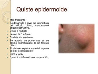 Quiste epidermoide
   Más frecuente
   Se desarrolla a nivel del infundíbulo
    del folículo piloso, mayormente
    origen obstructivo.
   Único o múltiple
   Lesión de 1 a 5 cm
   Cosistencia renitente
   Se aprecia un punto que es un
    orificio queratinizado de un folículo
    piliso.
   Al abrirse expulsa material espeso
    de olor desagradable.
   Cara y tórax
   Episodios inflamatorios: supuración
 