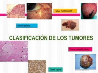 Tumor melanocítico




  Tumor epitelial




CLASIFICACIÓN DE LOS TUMORES
                                        Tumor mesodérmicos




                    Tumor neural
 