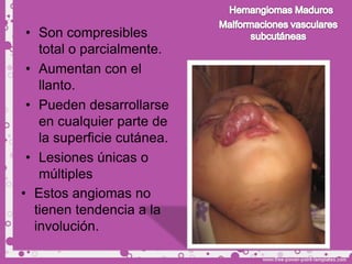 • Son compresibles
   total o parcialmente.
 • Aumentan con el
   llanto.
 • Pueden desarrollarse
   en cualquier parte de
   la superficie cutánea.
 • Lesiones únicas o
   múltiples
• Estos angiomas no
  tienen tendencia a la
  involución.
 