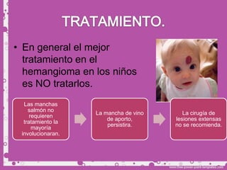 • En general el mejor
  tratamiento en el
  hemangioma en los niños
  es NO tratarlos.
  Las manchas
    salmón no
                   La mancha de vino      La cirugía de
     requieren
                       de aporto,      lesiones extensas
  tratamiento la
                       persistira.     no se recomienda.
      mayoría
 involucionaran.
 