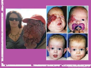 Derma nevos y hemangiomas