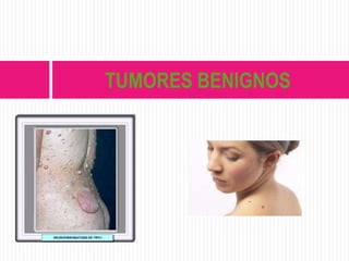 TUMORES BENIGNOS
 
