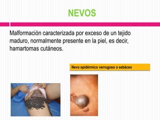 NEVOS
Malformación caracterizada por exceso de un tejido
maduro, normalmente presente en la piel, es decir,
hamartomas cutáneos.

                         Nevo epidérmico verrugoso o sebáceo
 