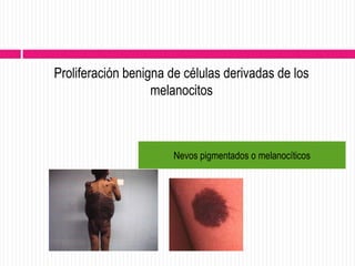 Proliferación benigna de células derivadas de los
                   melanocitos



                      Nevos pigmentados o melanocíticos
 