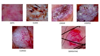 Dermoscopy in Dermatology: Principles, Patterns, and Clinical ...