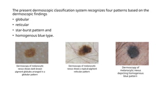 Dermoscopy in Dermatology: Principles, Patterns, and Clinical ...