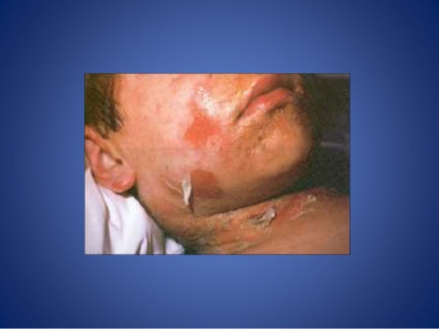 ivermectin in dermatology treatment ivermectin in dermatology treatment