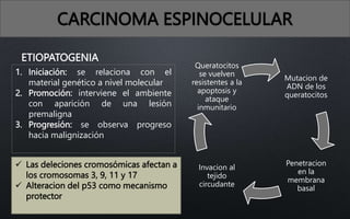 CARCINOMA ESPINOCELULAR
ETIOPATOGENIA
1. Iniciación: se relaciona con el
material genético a nivel molecular
2. Promoción: interviene el ambiente
con aparición de una lesión
premaligna
3. Progresión: se observa progreso
hacia malignización
Mutacion de
ADN de los
queratocitos
Penetracion
en la
membrana
basal
Invacion al
tejido
circudante
Queratocitos
se vuelven
resistentes a la
apoptosis y
ataque
inmunitario
 Las deleciones cromosómicas afectan a
los cromosomas 3, 9, 11 y 17
 Alteracion del p53 como mecanismo
protector
 