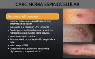 CARCINOMA ESPINOCELULAR
Factores predisponentes
• Lesiones precursoras: queratosis actinica y
enfermedad de Bowen
• Exposición a la radiación UV y ionizante
• Carcinógenos ambientales como arsénico o
hidrocarburos aromáticos como alquitrá
• Inmunosupresión crónica
• Factores térmicos por exposición exagerada al
calor
• Infección por VPH
• Genodermatosis, albinismo, xerodermia
pigmentosa, poroqueratosis, etc
 