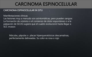 CARCINOMA ESPINOCELULAR
CARCINOMA ESPINOCELULAR IN SITU
Manifestaciones clínicas
Las lesiones muy a menudo son asintomáticas, pero pueden sangrar.
La formación de nódulos o el comienzo de dolor espontáneo o a la
palpación de SCCIS sugiere que el cuadro evolucionó hasta llegar a
SCC invasor.
.
Máculas, pápulas o placas hiperqueratósicas descamativas,
perfectamente delineadas. Su color es rosa o rojo
 