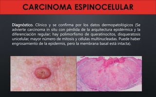 Diagnóstico. Clínico y se confirma por los datos dermopatológicos (Se
advierte carcinoma in situ con pérdida de la arquitectura epidérmica y la
diferenciación regular; hay polimorfismo de queratinocitos, disqueratosis
unicelular, mayor número de mitosis y células multinucleadas. Puede haber
engrosamiento de la epidermis, pero la membrana basal está intacta).
 