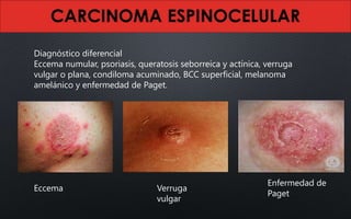 Diagnóstico diferencial
Eccema numular, psoriasis, queratosis seborreica y actínica, verruga
vulgar o plana, condiloma acuminado, BCC superficial, melanoma
amelánico y enfermedad de Paget.
Eccema Verruga
vulgar
Enfermedad de
Paget
 