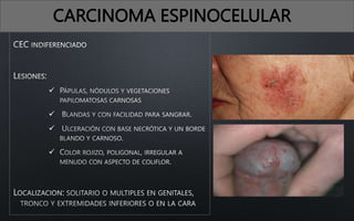 



CARCINOMA ESPINOCELULAR
 
