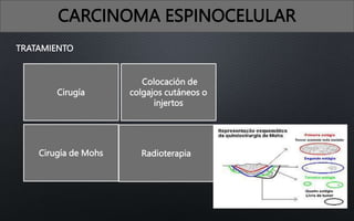 TRATAMIENTO
CARCINOMA ESPINOCELULAR
Cirugía
Cirugía de Mohs
Colocación de
colgajos cutáneos o
injertos
Radioterapia
 