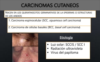 CARCINOMAS CUTANEOS
NACEN EN LOS QUERATINOCITOS GERMINATIVOS DE LA EPIDERMIS O ESTRUCTURAS
DE LOS ANEXOS
2. Carcinoma de células basales (BCC, basal cell carcinoma)
1. Carcinoma espinocelular (SCC, squamous cell carcinoma)
Etiología
 Luz solar: SCCIS / SCC I
 Radiación ultravioleta
 Virus del papiloma
humano
 