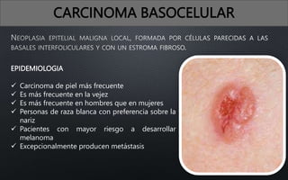 CARCINOMA BASOCELULAR
EPIDEMIOLOGIA
 Carcinoma de piel más frecuente
 Es más frecuente en la vejez
 Es más frecuente en hombres que en mujeres
 Personas de raza blanca con preferencia sobre la
nariz
 Pacientes con mayor riesgo a desarrollar
melanoma
 Excepcionalmente producen metástasis
 