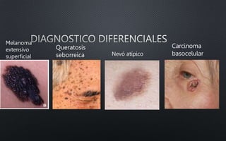 Melanoma
extensivo
superficial Nevó atípico
Queratosis
seborreica
Carcinoma
basocelular
 
