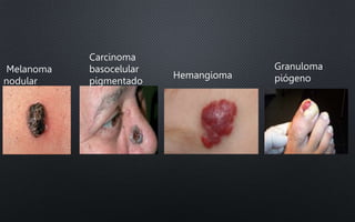 Melanoma
nodular
Carcinoma
basocelular
pigmentado
Hemangioma
Granuloma
piógeno
 
