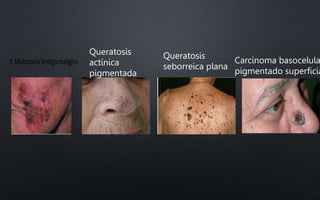 Queratosis
actínica
pigmentada
Queratosis
seborreica plana
Carcinoma basocelula
pigmentado superficia
 