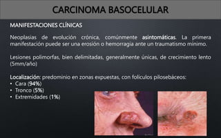 MANIFESTACIONES CLÍNICAS
Neoplasias de evolución crónica, comúnmente asintomáticas. La primera
manifestación puede ser una erosión o hemorragia ante un traumatismo mínimo.
Lesiones polimorfas, bien delimitadas, generalmente únicas, de crecimiento lento
(5mm/año)
Localización: predominio en zonas expuestas, con folículos pilosebáceos:
• Cara (94%)
• Tronco (5%)
• Extremidades (1%)
CARCINOMA BASOCELULAR
 