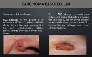 CARCINOMA BASOCELULAR
Se conocen 5 tipos clínicos:
BCC nodular: es una pápula o un
nódulo translúcido o “perlino”, del color
de la piel o rojizo, con una superficie
lisa con telangiectasias, bordes
perfectamente definidos y consistencia
firme.
BCC ulceroso: el carcinoma
incluye una úlcera (cubierta a menudo
por una costra), con un borde elevado
(úlcera terebrante) que es translúcido,
perlino, liso con telangiectasias y de
consistencia firme.
 
