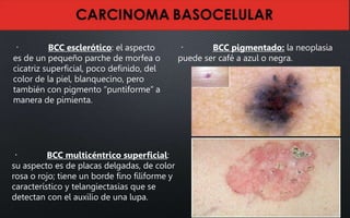 BCC esclerótico: el aspecto
es de un pequeño parche de morfea o
cicatriz superficial, poco definido, del
color de la piel, blanquecino, pero
también con pigmento “puntiforme” a
manera de pimienta.
BCC multicéntrico superficial:
su aspecto es de placas delgadas, de color
rosa o rojo; tiene un borde fino filiforme y
característico y telangiectasias que se
detectan con el auxilio de una lupa.
BCC pigmentado: la neoplasia
puede ser café a azul o negra.
 