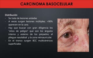 Distribución
- Se trata de lesiones aisladas
- A veces surgen lesiones múltiples; >90%
aparecen en la cara.
- Hay que buscar con gran diligencia los
“sitios de peligro” que son los ángulos
interno y externo de los párpados; el
pliegue nasolabial y la zona retroauricular.
- En el tronco surgen BCC multicéntricos
superficiales
 