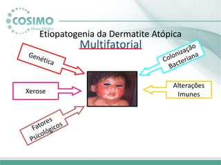 Etiopatogenia da Dermatite Atópica
Multifatorial
Alterações
Imunes
Xerose
 