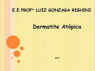 E.E.PROFº LUIZ GONZAGA RIGHINI
Dermatite Atópica
2015
 