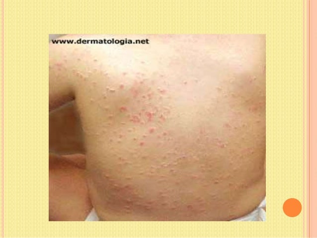 Come distinguere la psoriasi da un fungo della pelle di piede