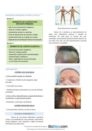 RESUMO DA DIFERENÇA ENTRE AS DUAS
TRATAMENTO
LESÕES LOCALIZADAS
1. Fase exudativa aguda ou subaguda:
- Compressas e banhos de permanganato, água
boricada;
- Corticoides em cremes;
- Antibioticoterapia concomitante em caso de infecção
secundária.
2. Fase crônica (liquenificada), na qual predominam a
xerodermia e o espessamento da pele
- Emolientes, corticoides, ceratolíticos.
LESÕES DISSEMINADAS
- Corticosteroide sistêmico em baixas doses.
ECZEMA SEBORREICO
Trata-se de uma doença inflamatória, superficial,
crônica, com predileção por couro cabeludo, sobrancelhas,
bordos palpebrais, sulco nasolabial e região pré-esternal
(chamadas áreas seborreicas)
Áreas seborreicas em vermelho
Nestes há a tendência ao desenvolvimento de
lesões mais inflamatórias, extensas e rebeldes ao
tratamento. De modo geral, os homens são mais
acometidos, principalmente quando há história familiar. Em
sua forma mais leve, ela está frequentemente associada
com o estresse e a ansiedade.
Descarregado por Rodolfo Quintela (sonhadorsempre@hotmail.com)
lOMoARcPSD|15205287
 