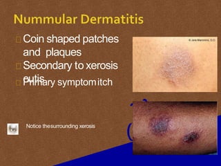 Three Coin Rashes Dermatitis eczema by dr.Hari dagal | PPTX