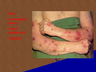 Three Coin Rashes Dermatitis eczema by dr.Hari dagal | PPTX