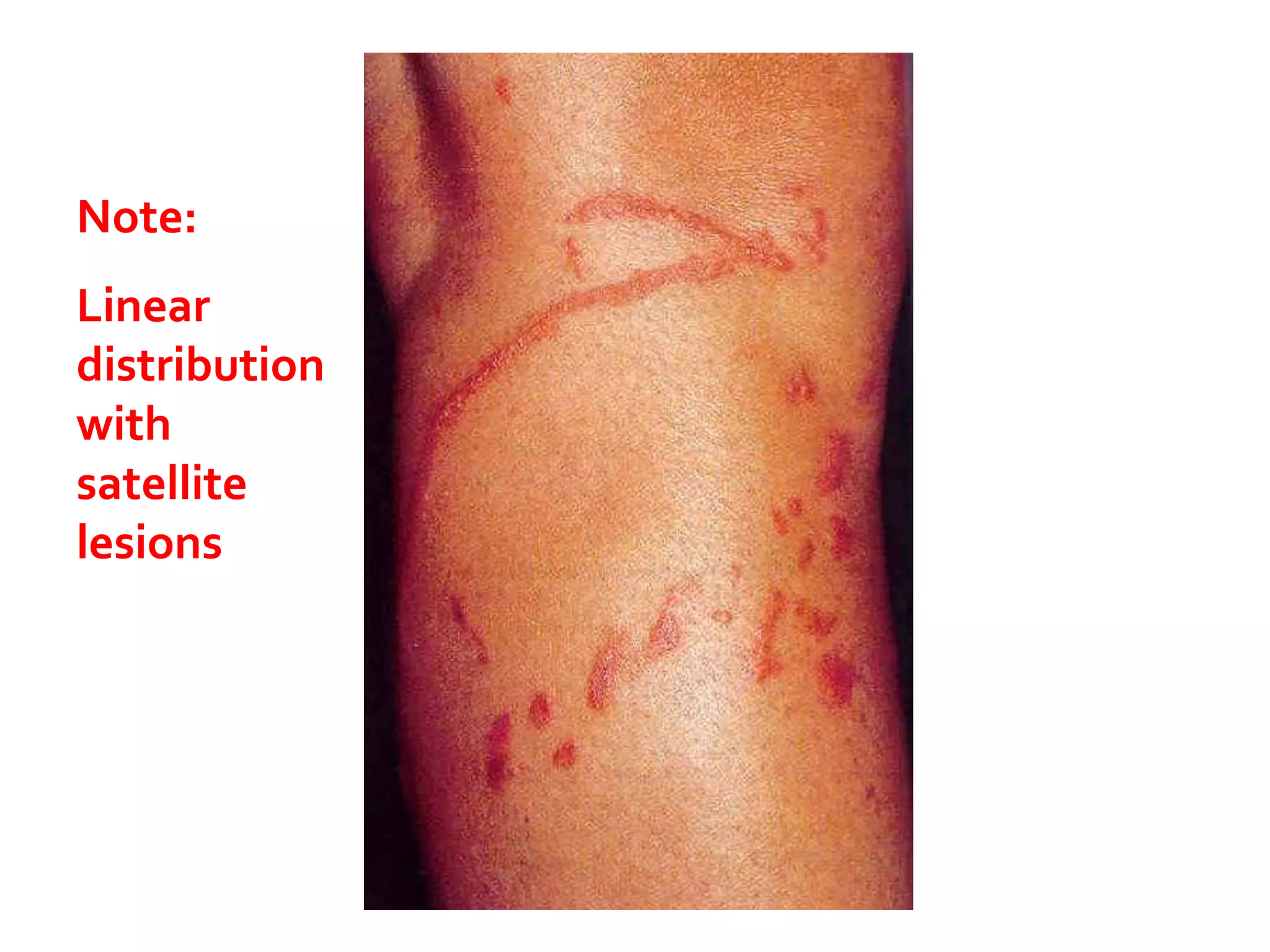 Linear Rash Diffuse Dermatitis | PPTX
